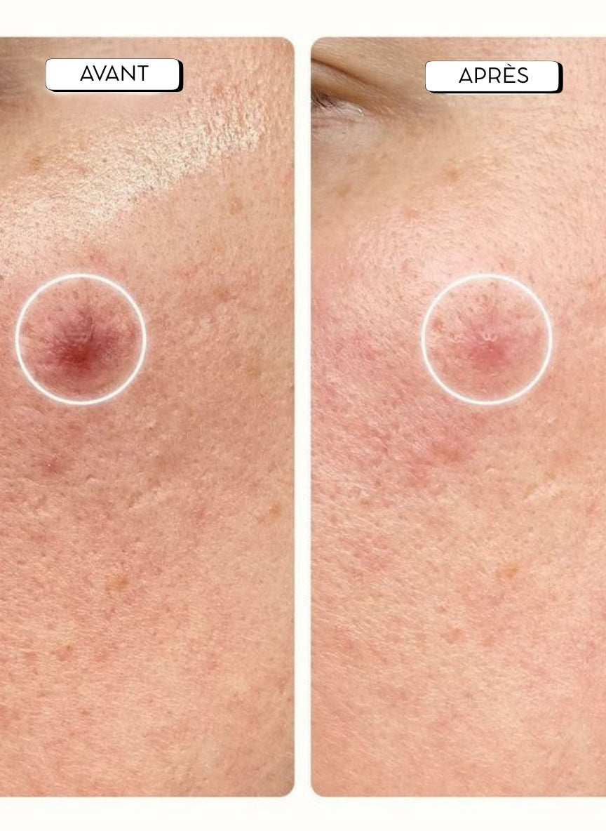 Patch anti-boutons (36 patchs)