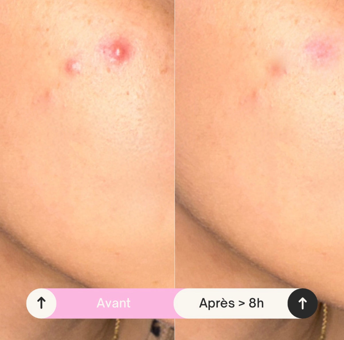 Patch anti-boutons