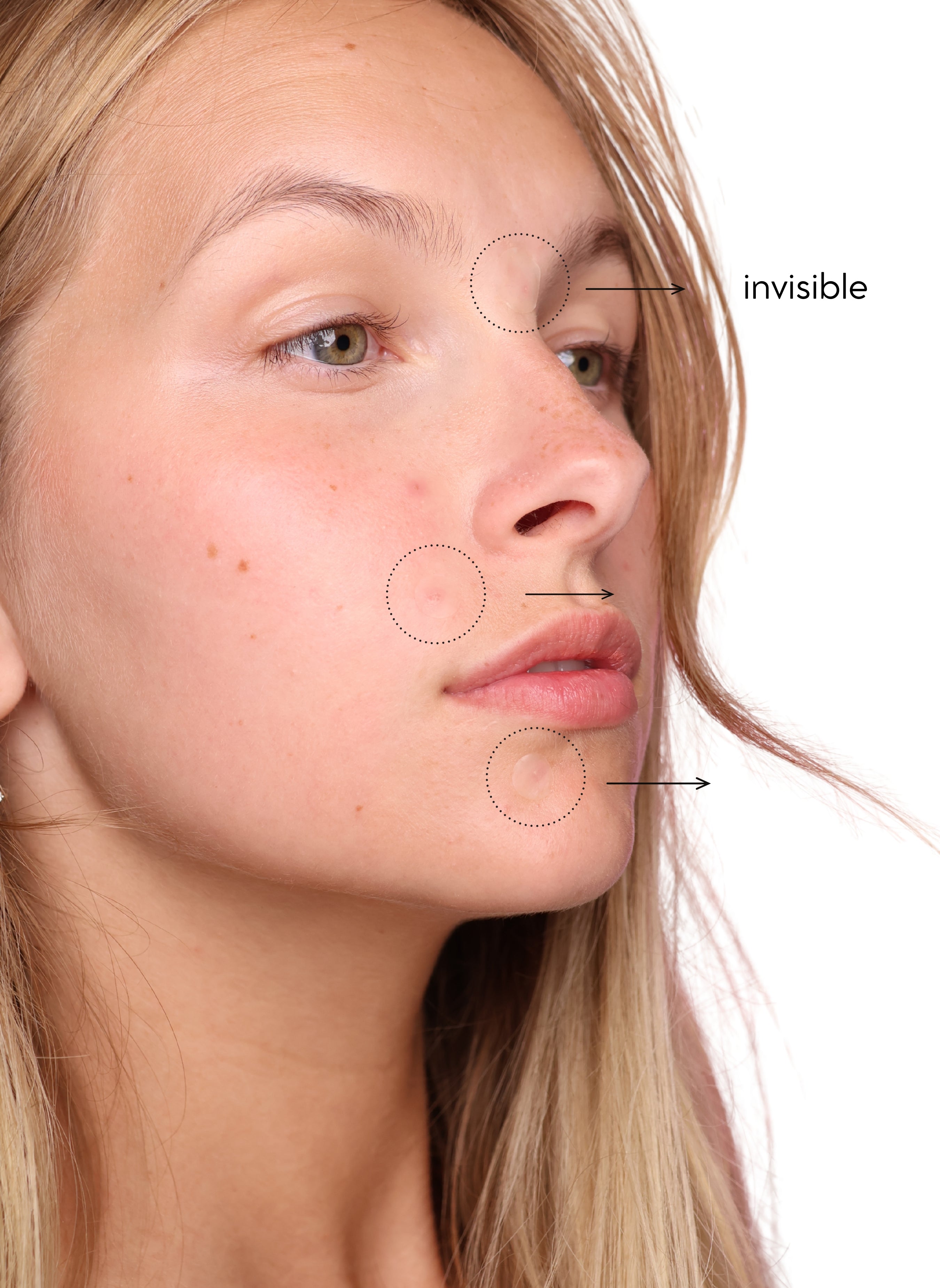 Patch anti-boutons (36 patchs)