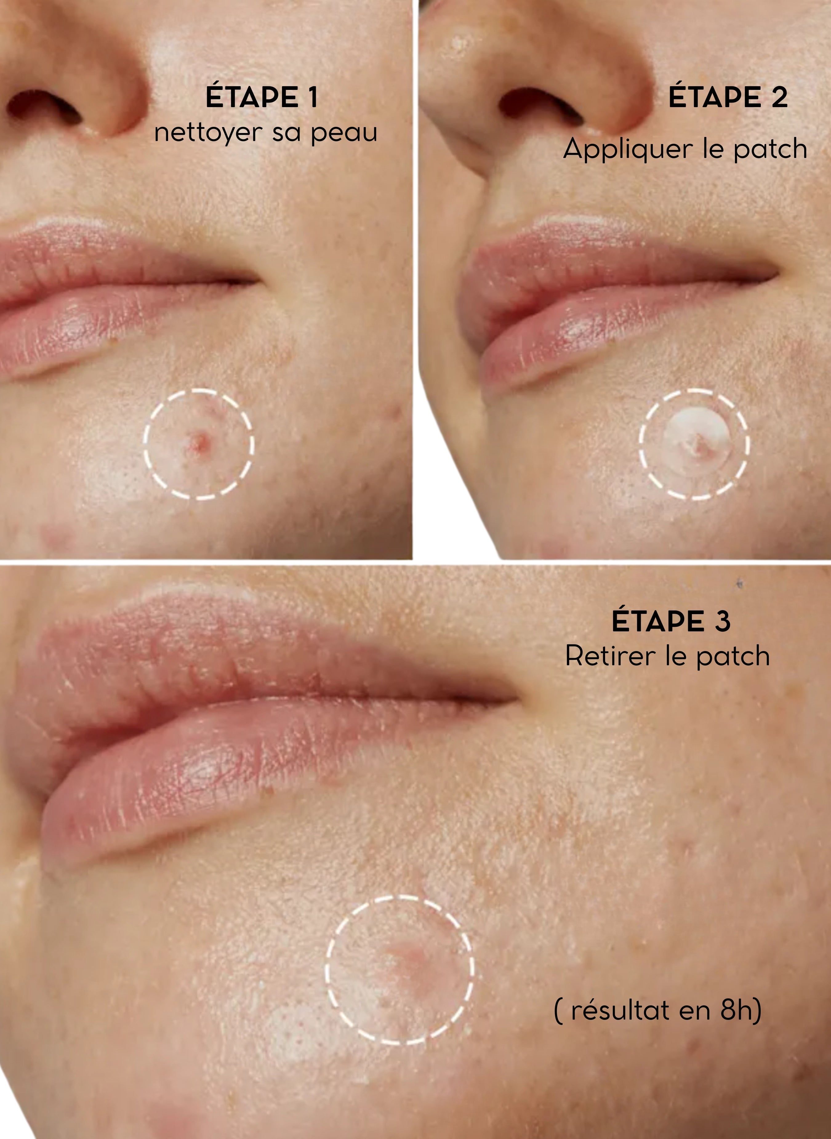 Patch anti-boutons (36 patchs)